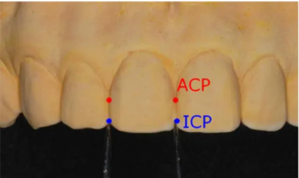 Fig. 3. The most incisal and apical points on both mesial and distal contact areas were marked