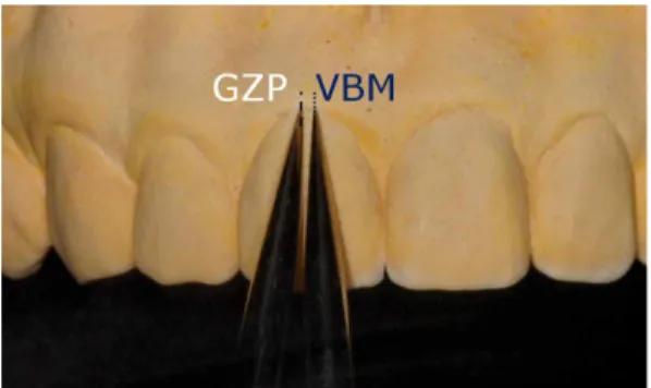 Fig. 6. The distance of the highest gingival margin position(GZP) to the vertical bisected midline(VBM) was measured.