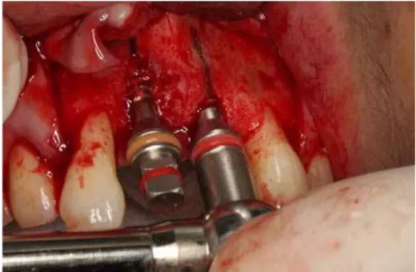 Fig. 4. Mucoperiosteal full-thickness flap was elevated. Buccolingual ridge width is inadequate