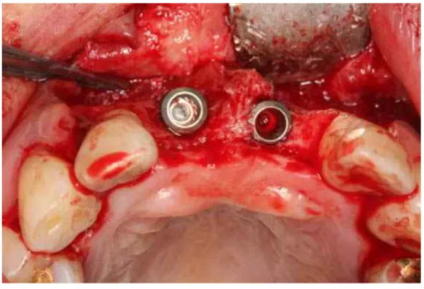 Fig. 7. Autogenous tooth bone graft material was grafted around the peri-implant defects and over the labial cortical plate.