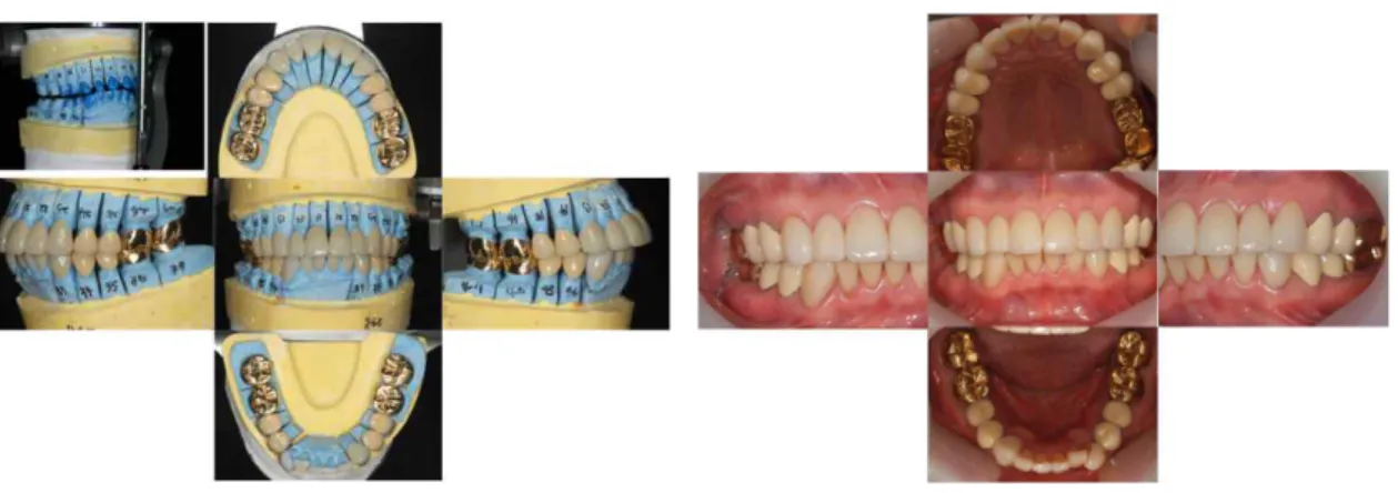 Fig. 7. Final restorations 총괄 및 고안 치아의 마모를 보이는 환자가 진료실을 찾는 이유는 보통 심미적인 이유, 기능적인 이유, 지 각 과민증의 증가 때문이고 이때 먼저 병인 요 소들의 조절이 필요하고, 환자의 나이가 고려되 어야 한다