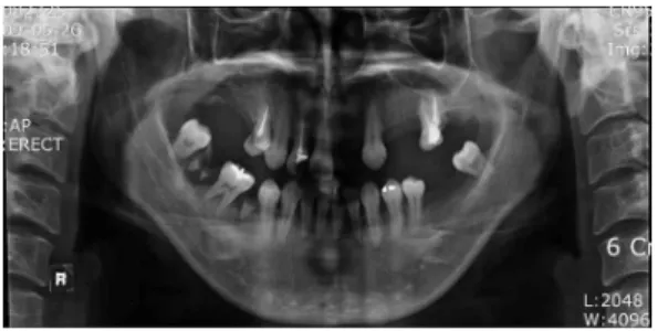 Fig. 4. Face-bow Transfer and V.D check