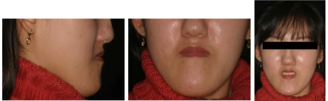 Fig. 14. Extra-oral views after the final treatment 총괄 및 고안 III급 부정교합환자의 치료는 우선 반대교합의 원인과 양상이 진정한 골격성 이상 관계인지 잘 못된 치아위치나 축의 이상에서 생긴 가성 반대 교합인지를 파악해야한다