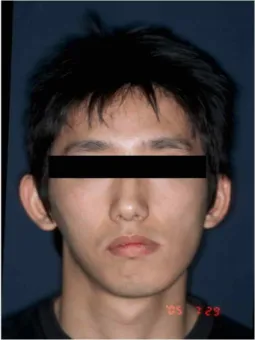 Fig. 1. Initial frontal view of face showed facial asymmetry with mandible deviation.