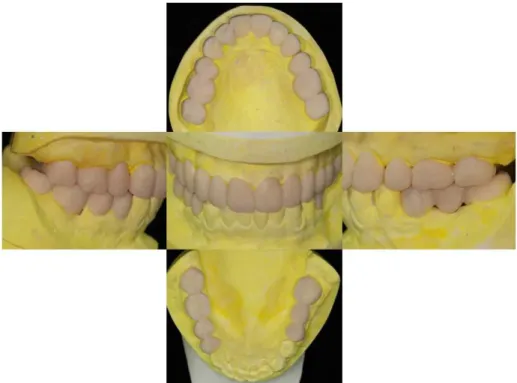 Fig. 10. Provisional prostheses made from diagnostic wax-up.
