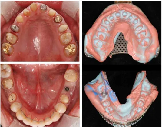 Fig. 13. Teeth preparation and impression taking.