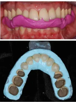 Fig. 14. Bite registration with provisional pro- pro-stheses and silicone bite material.