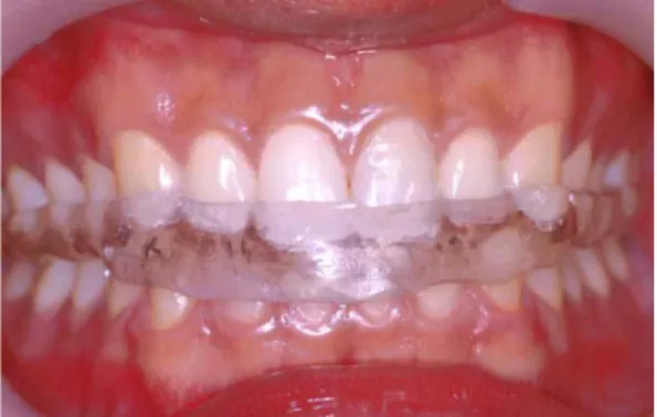 Fig. 2. Splint placed in the upper dentition of the subject.