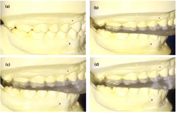 Fig. 3. Maxillary clear acrylic resin splint.