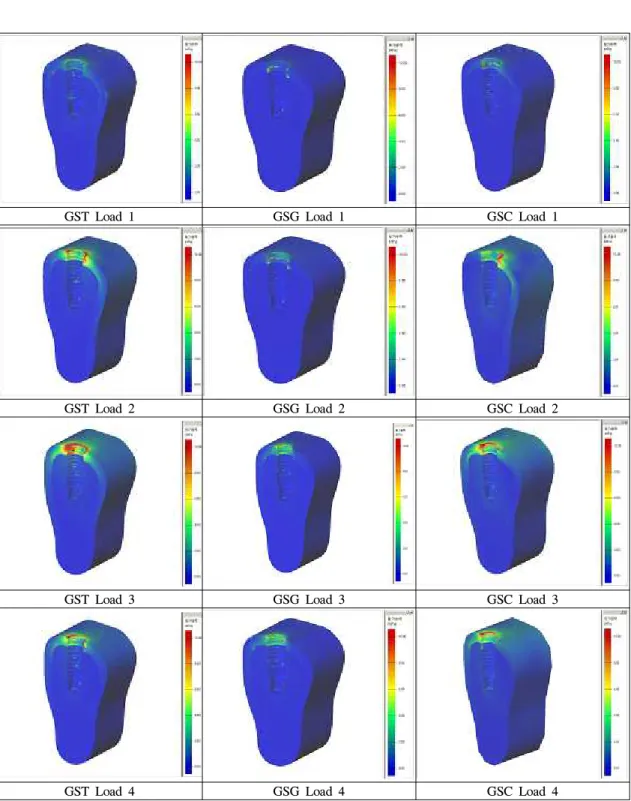 Fig. 4. The stress contours of bone in model under loading condition 1, 2, 3, 4.
