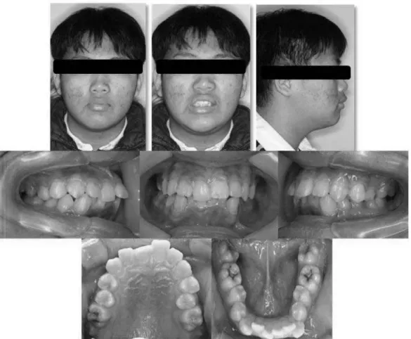 Fig 1. Pretreatment intraoral &amp; extraoral photographs.