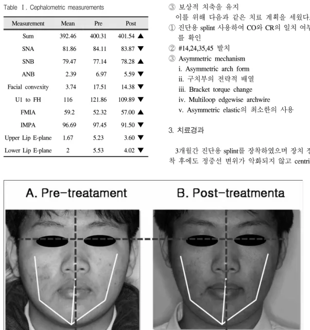 Fig 3. A. Pretreatment frontal photo, B. Posttreatment frontal photo