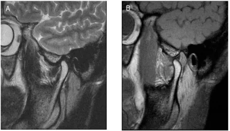 Fig. 2. 개폐구시 턱관절의 MRI 영상 (시상면) 한 진단 도구이나, 현재는 턱관절, 하악지, 과두 의 모양과 병적인 소견을 평가하기 위해 전산화 단층촬영(computed tomography; CT)으로 대체되 고 있다