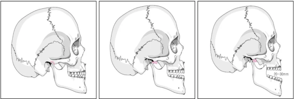 Fig. 3. 턱관절 내장증시 과두 걸림 현상 간헐적인 걸림을 동반한 턱관절 소리의 병력이 존재할 수 있다. MRI상으로 비정복성 원판변위 (폐구성 과두걸림)이 나타나며, 과두의 퇴행성 변화를 보여주기도 한다