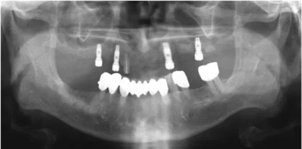 Fig. 3. Initial diagnostic casts mounting.