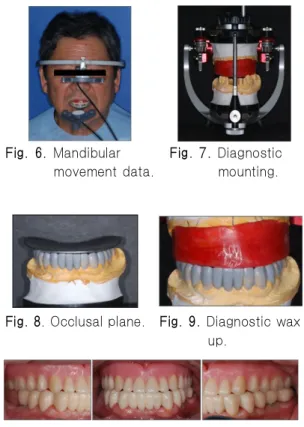 Fig. 5. Panoramic view after removing of existed FPDs and fixture on #25.