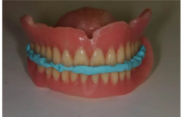 Fig. 1. Frontal view of edentulous arches at an approximated occlusal vertical dimension.