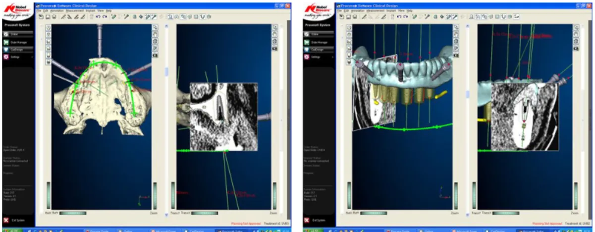 Fig. 3. Three dimensional image-based treatment planning software(Procera software; Nobel Biocare AB)