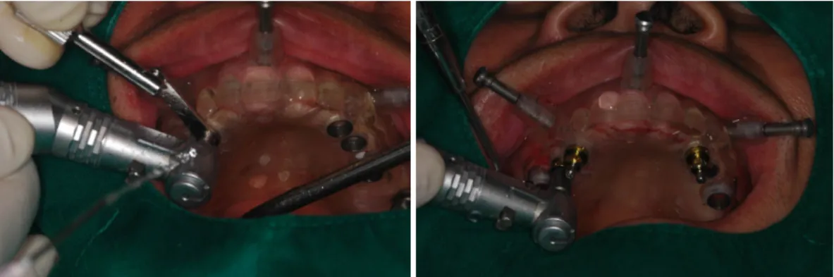 Fig. 8. A, Preparation of alveolus using metal sleeves B, Fixture placement.