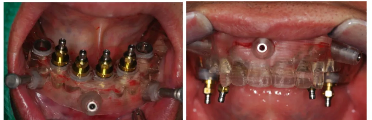 Fig. 9. Implant installation using surgical templates.