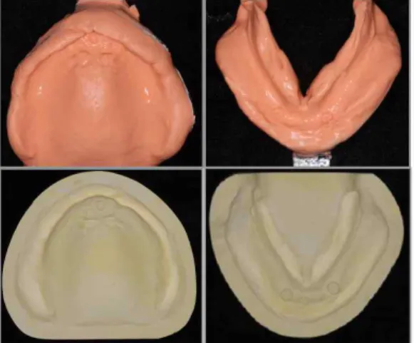 Fig. 6. 상하악 예비인상 및 진단모형 Fig. 7. 상하악 개인트레이 지력이 감소되면 남성부를 쉽게 교체할 수 있고 특별한 비적응증이 존재하지 않는 Locator ® attachment 9) 의 사용을 결정하였다