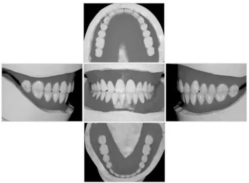 Fig. 11. 인공치 배열. 크기, 형태를 결정하고, 교합기에 부착된 모형상 에서 인공치를 배열하였다(Fig. 11). 기능시 양악 총의치의 안정성을 고려하여 양측성 균형교합을 부여하도록 하였다