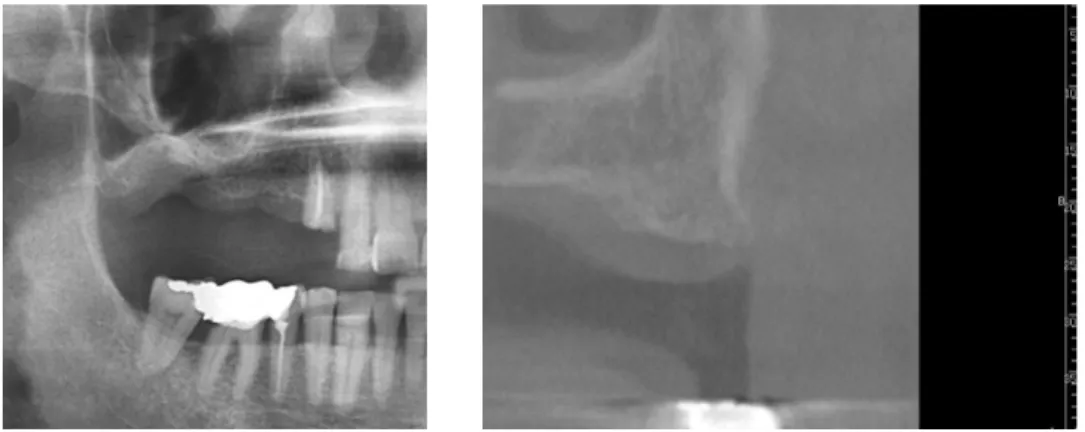 Fig. 2. Preoperative panoramic view and preoperative computed tomograph of the right maxillary 2nd molar area