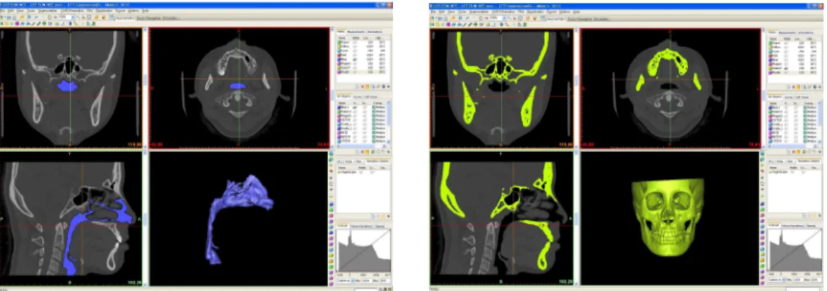 Fig. 1. Formation of nasal airway and skull 3D image.