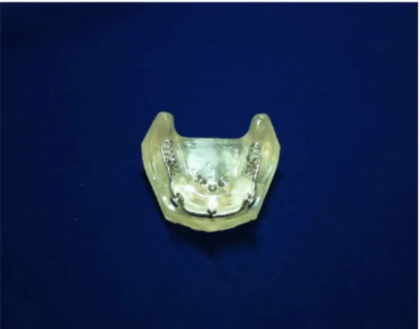 Fig. 4. Magnetic attachment overdenture sample seated on mandibular model, with nuts and bolts securely fastened