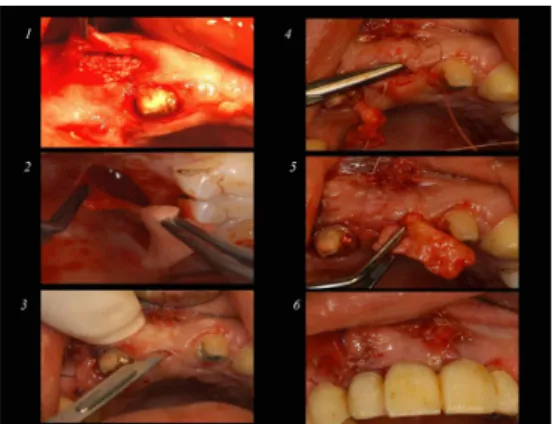 Fig. 4. Implants installation.
