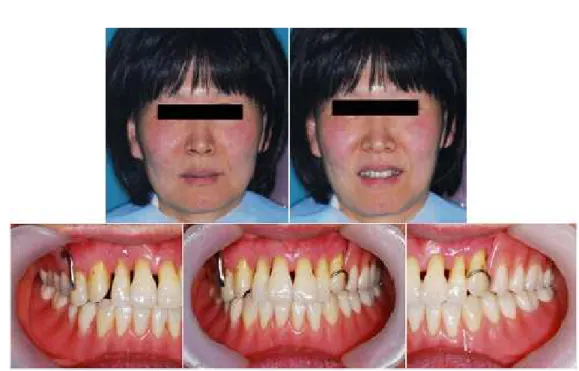 Fig. 13. 의치 장착 후 구내 및 구외소견.
