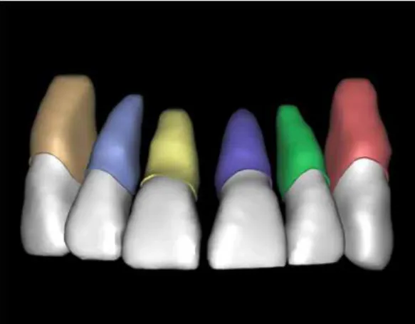 Fig. 2. Maxillary anterior teeth and periodental ligament were reconstructed by Mimics program (frontal view).