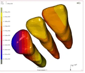 Fig. 17. 3D representation of displacement on Y direction in the multi model (palatal view)
