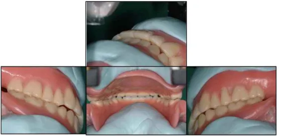 Fig. 20. 교합기 재부착을 통한 교합조정.