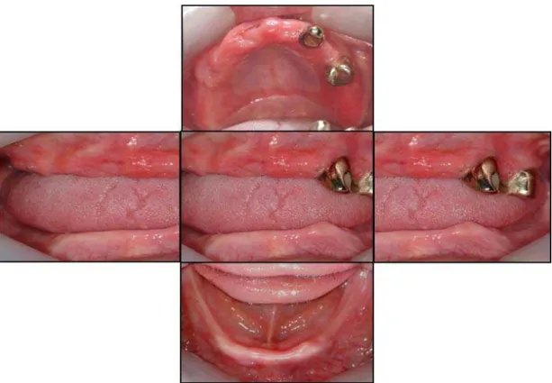 Fig. 2. 구강내 소견, 상악 우측 #11, 12, 14 치아의 발거로 인한 치유과정 중의 치은이 관찰되며, 좌측 견치는 open-faced 금 주조관으로, 제2소구치는 금주조관으로 수복되어있음