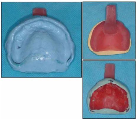 Fig. 10. 상악의 인상채득. 개인트레이를 제작하여 변연형성 후 인상채득함.