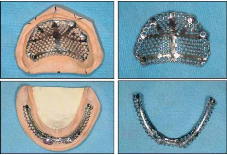 Fig. 13. 상하악 주모형과 금속 구조물의 모습.