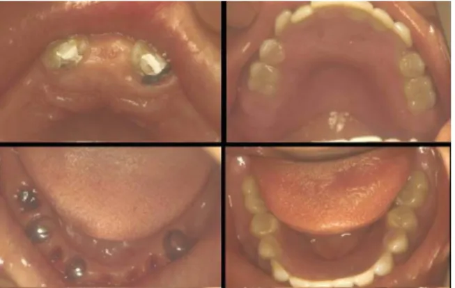 Fig. 14-1. 인공치아 배열이 완료된 상하악 교합면 모습: 상악 양측 중절치 치관도 삭제를 한 다음 인공 치아를 배열한다 . Fig. 14-2. 완성된 이행의치 구강내에서 자가중합레진으: 로 wash 를 위해 지대치 부분은 구멍을 뚫어 서 여분의 레진이 빠져나가도록 한다 