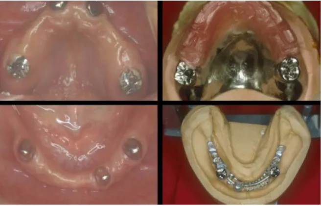 Fig. 16-2. 작업모형 및 occlusal rim 제작