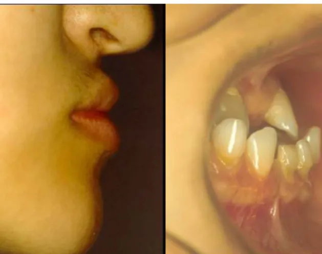 Fig. 3-1. 안모의 profile 분석 : habitual CO 상태와 안정시 하악위 간의 큰 차이가 있음을 확인 할 수 있다 . Fig. 3-2. 교합고경 분석시 이용 가능한 얼굴 길이 비례 에 관한 자료a1a2 b2 b1a1 = a2 ; Willis methodsb1 = b2 ; McGee