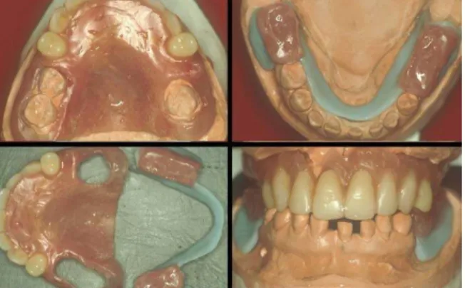 Fig. 11-1. 교합평면 설정 구강내에서 시적했던 : wax 에서 전치부 길이를 결정하고 구치부