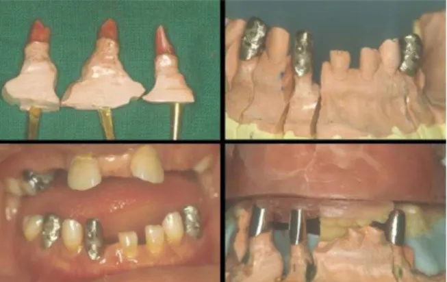 Fig. 11-4. 후방부 기준점인 구후융기 교합평면에 관한 : 동서양인의 자료가 거의 유사하다 .