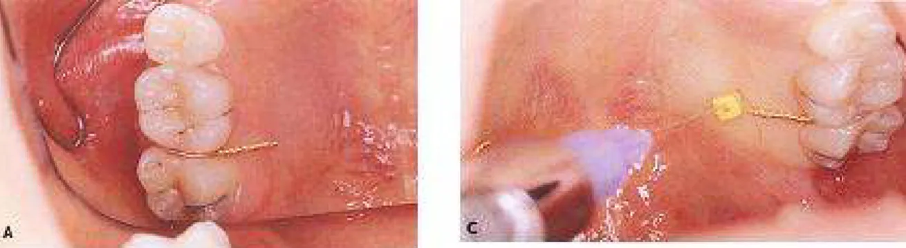 Fig. 2 . Pilot drill 로 홈 형성 후 contra-angle handpiece 로 식립