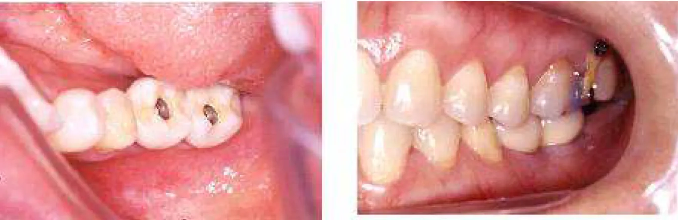 Fig. 12. 보철물 적합이 완료된 방사선 모습이다. Ⅳ 고찰 및 결과 . 본 증례의 경우 상악치아의 정출로 인해 압하 후 하악을 수복해야 되는 상황이었다 다수의 구치를 