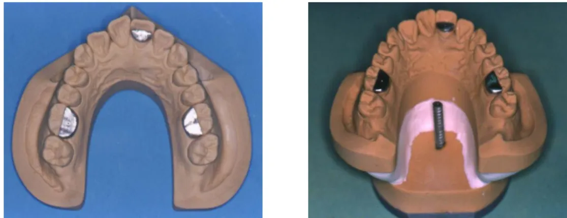 Fig. 5. Maxillary cast with palatal portion removed and maxillary cast after mounting.