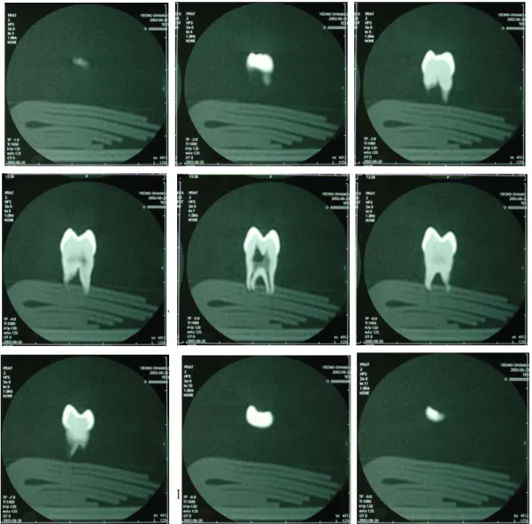 Fig. 2. Computerized tomography of natural tooth for CAD modelling(maxillary first premolar).