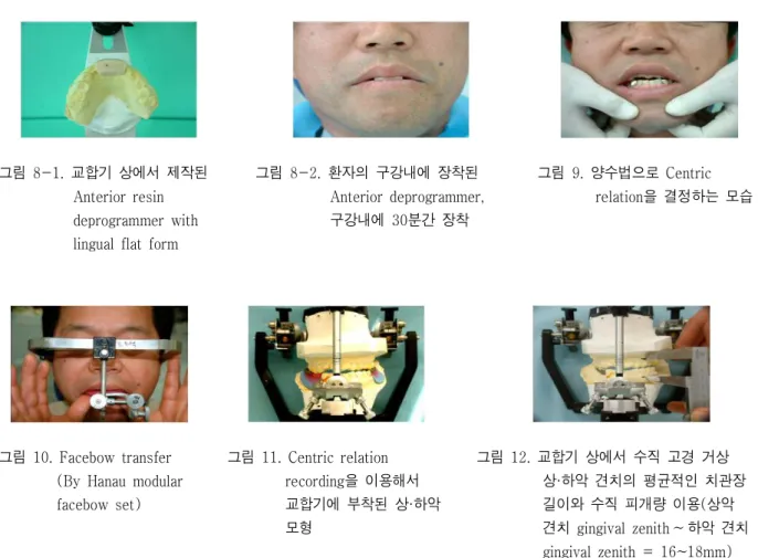 그림 7. 양수조작법의 적절한 손의 위치는 엄지로 하방력 을 주어서 치아를 이개 시키고 네 손가락은 상방 , 그리고 약간 전방으로 힘을 가해서 과두가 관절 융기후벽에 위치하도록 한다 이 손의 위치는 과 