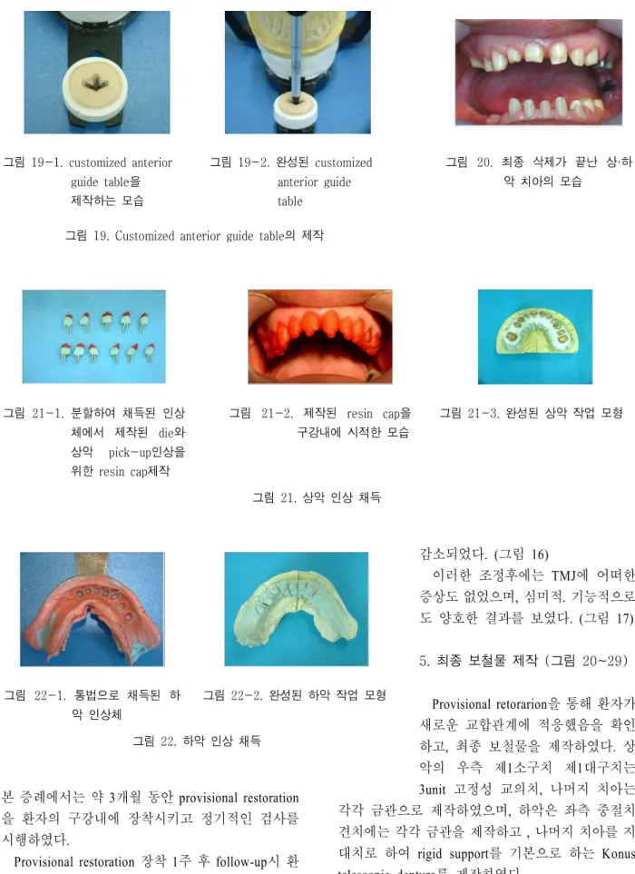 그림 21. 상악 인상 채득그림21-1. 분할하여 채득된 인상체에서 제작된die와상악pick-up인상을위한resin cap제작그림21-2. 제작된 resin cap 을구강내에 시적한 모습 그림 21-3