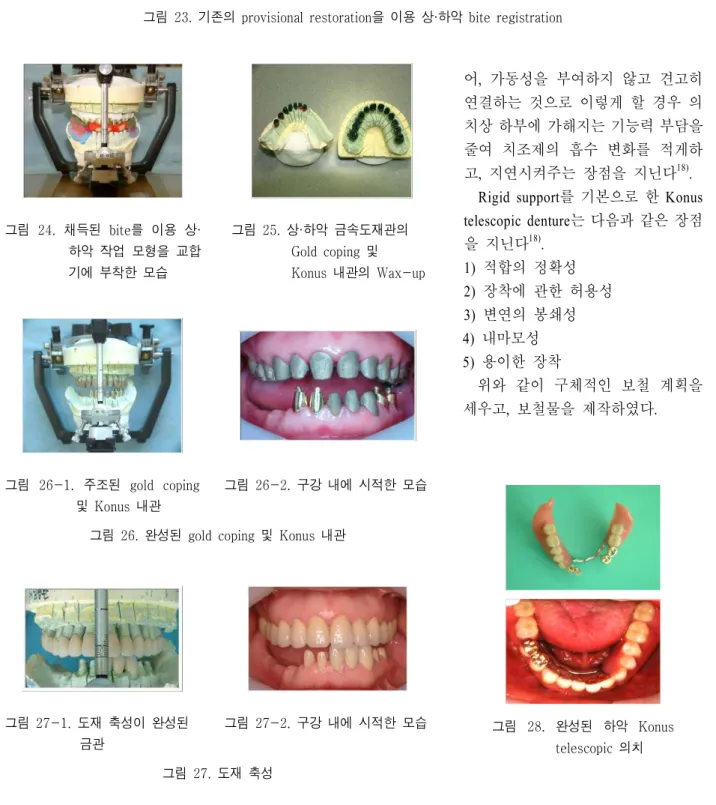그림 23. 기존의 provisional restoration 을 이용 상 하악 · bite registration그림23-1. 구치부쪽 임시 치아를으로 이용 전치stop부bite registration그림23-2 좌측 구치부쪽.biteregistration그림 23-3 최종적인