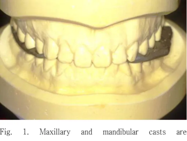 Fig. 1. Maxillary and mandibular casts are mounted on semiadjustable articulator.